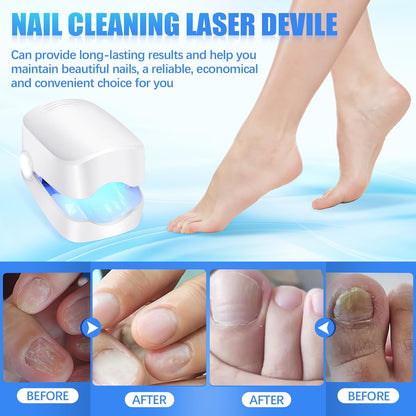 Rechargeable Nail Fungus Laser ? Anti-Fungal Device Toenails, Hands & Feet (Home Use)
